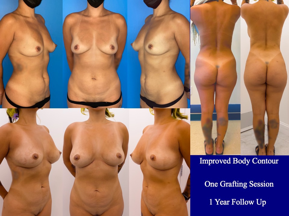 Breast Augmentation Before and After 3