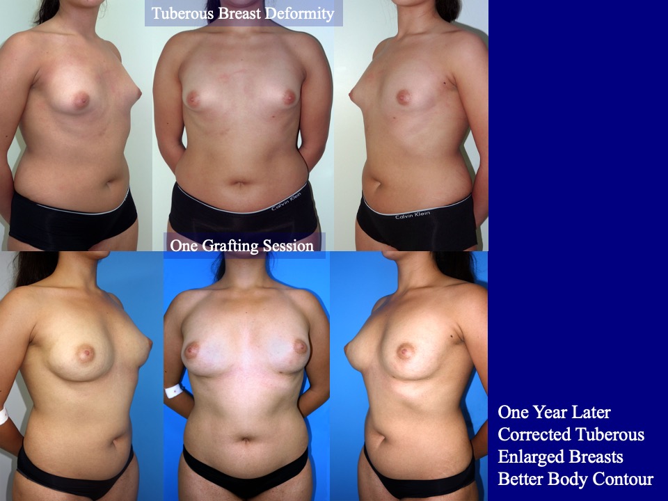 Breast Augmentation Before and After 30