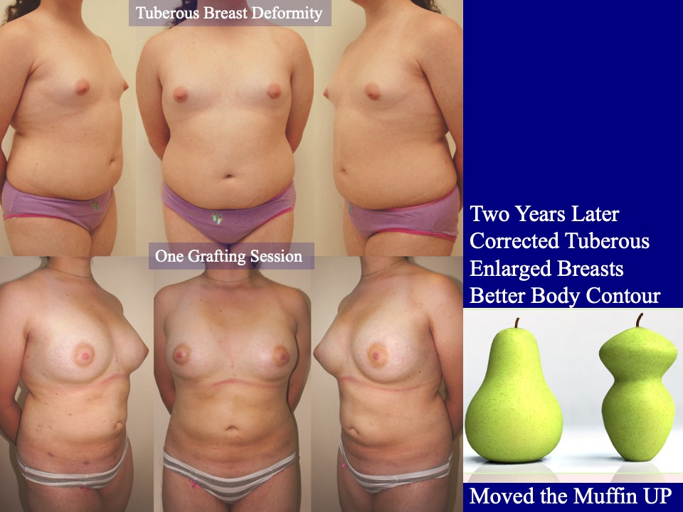 Breast Augmentation Before and After 31