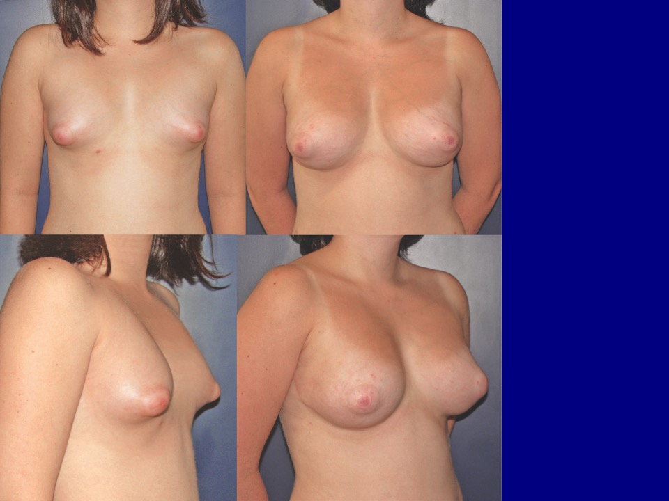 Breast Augmentation Before and After 32