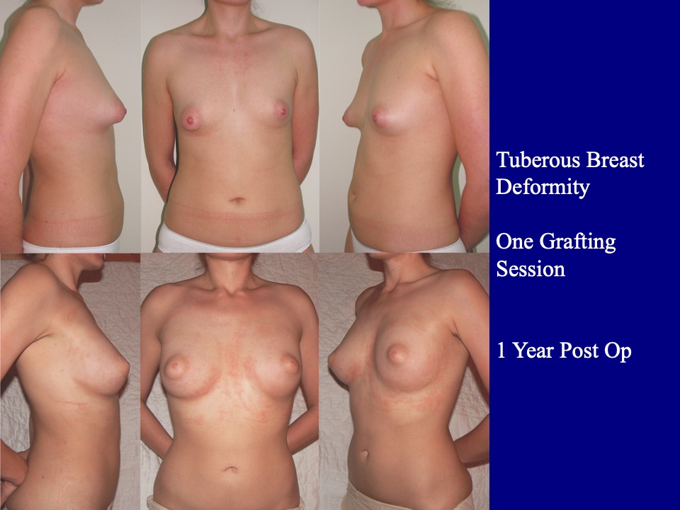 Breast Augmentation Before and After 33