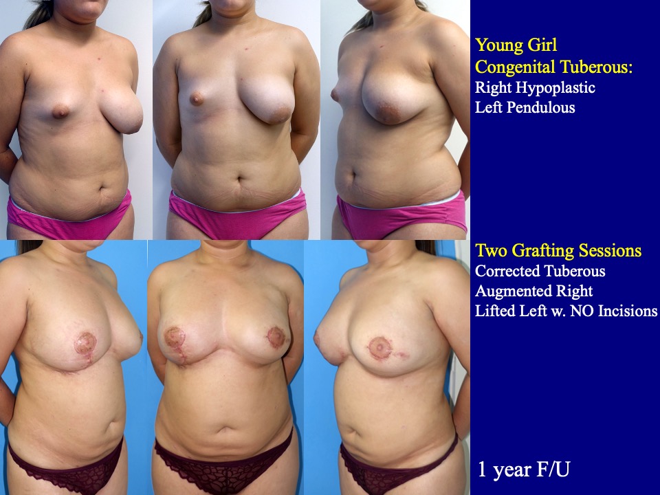 Breast Augmentation Before and After 34