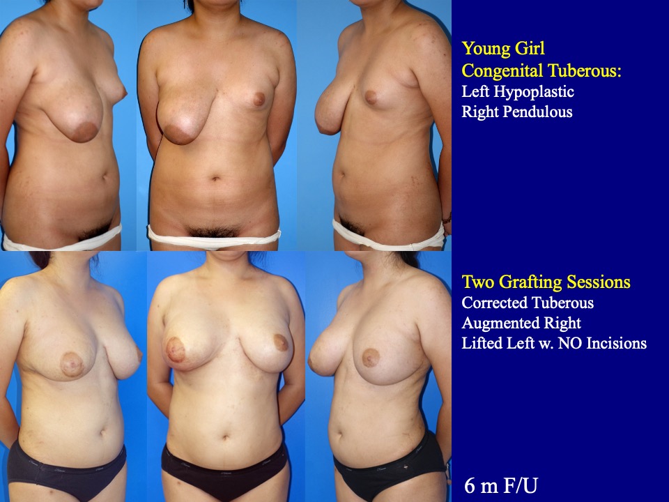 Breast Augmentation Before and After 35