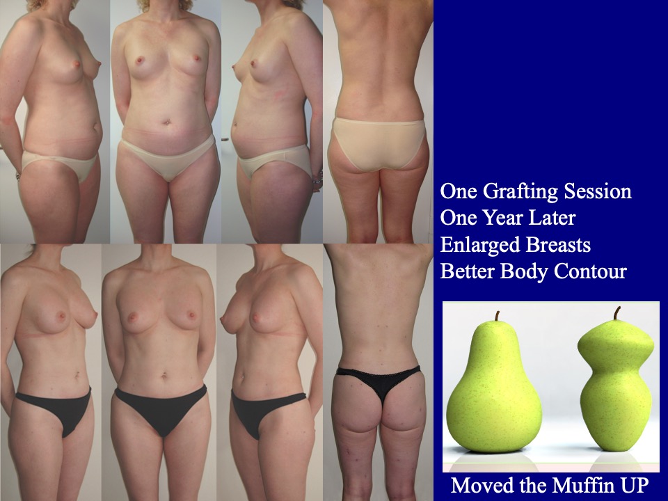 Breast Augmentation Before and After 36