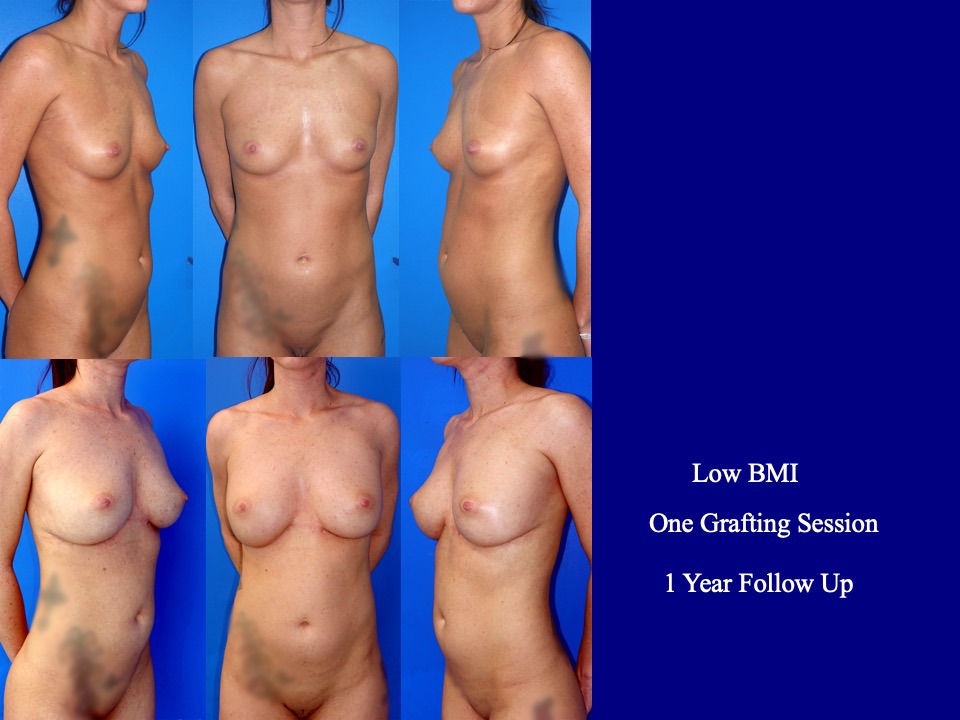 Breast Augmentation Before and After 4
