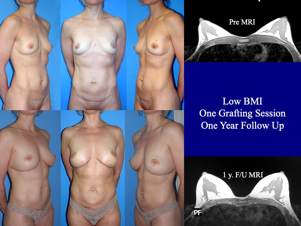 Breast Augmentation Before and After 5