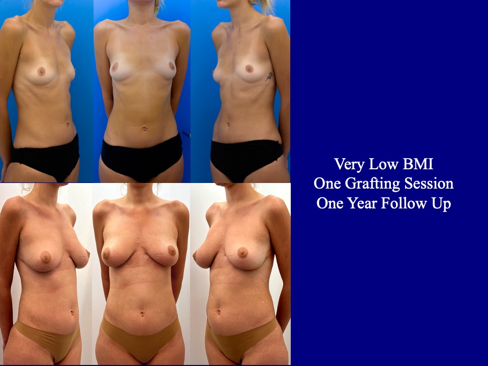 Breast Augmentation Before and After 7