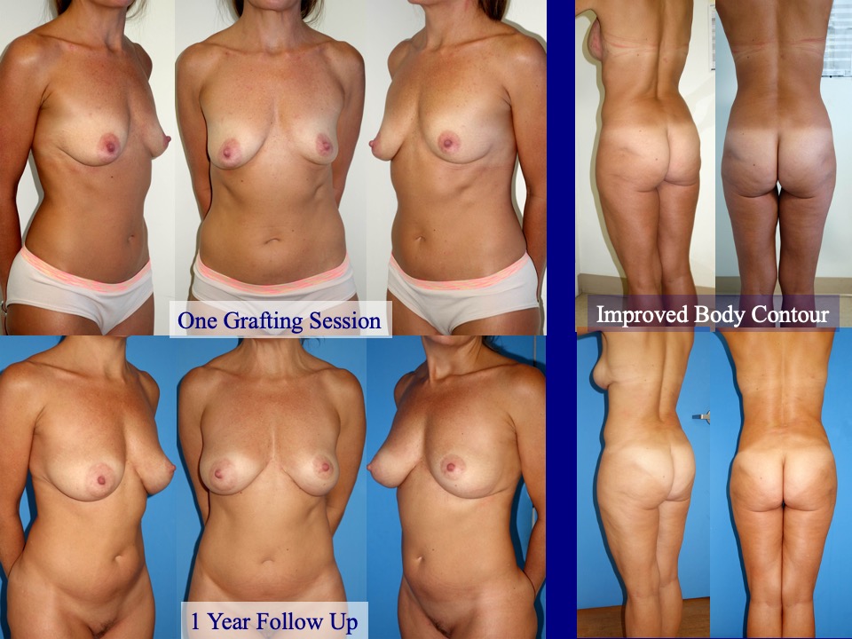 Breast Augmentation Before and After 8